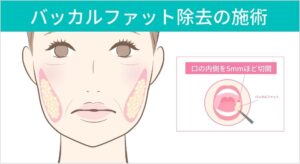 バッカルファット除去の施術方法