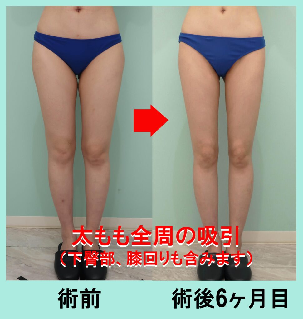 太もも脂肪吸引手術前後写真