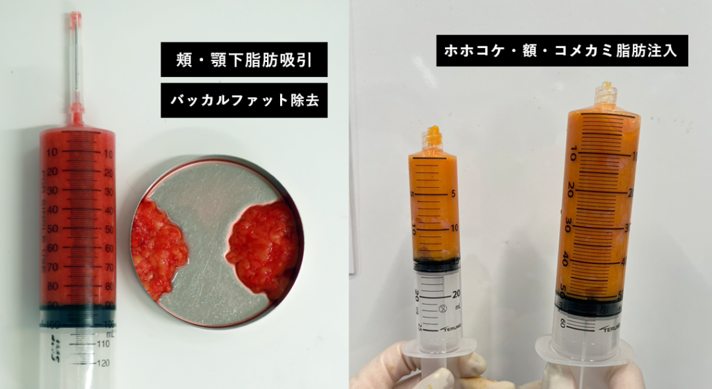 【リベンジハウス】20509 輪郭3点(Vライン形成・オトガイT字骨切り・頬骨L字骨切り)、頬・顎下の脂肪吸引・頬コケ・額こめかみ脂肪注入