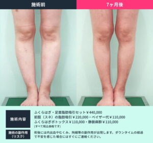 ふくらはぎ・足首の脂肪吸引のビフォーアフター
