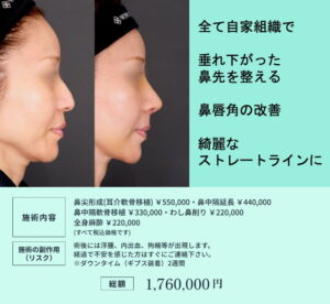鼻の複合手術のビフォーアフター01