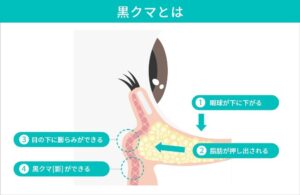 黒クマの原因と眼窩内断面図