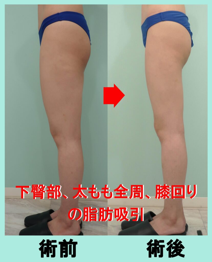 太もも脂肪吸引手術前後写真