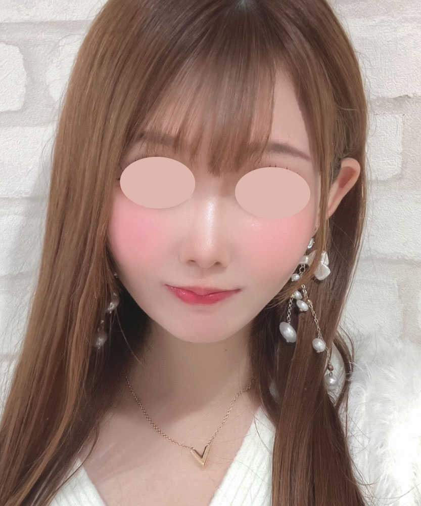 人生変わる小顔術 AFTER写真