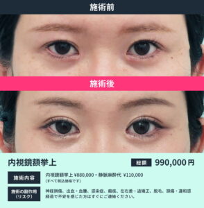 内視鏡額挙上のビフォーアフター