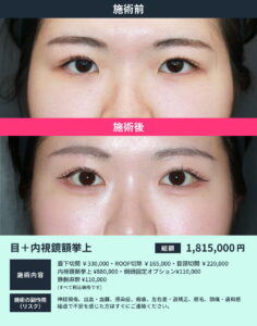 目元+内視鏡額挙上のビフォーアフター