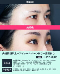 内視鏡額挙上+アイホールボーン+眉骨削りのビフォーアフター