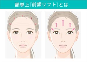 内視鏡額挙上の切開位置とリフトアップ方向