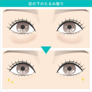 目の下たるみ取りのビフォーアフター
