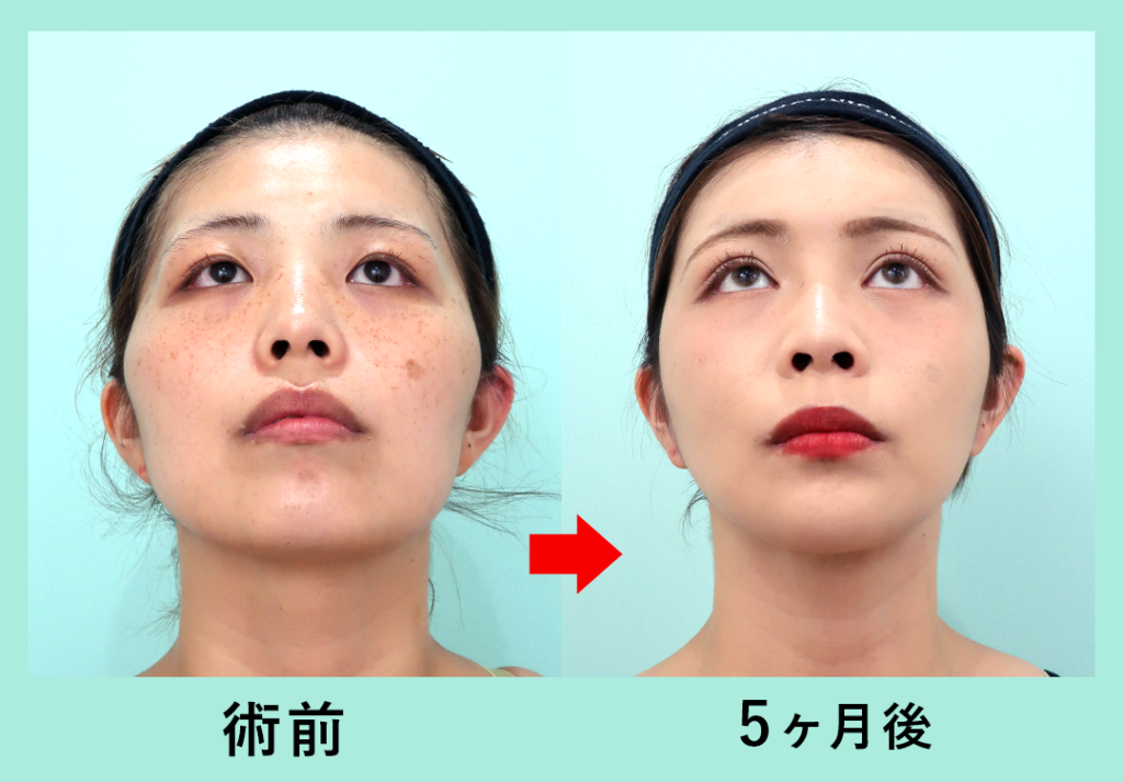 【リベンジハウス】20509 輪郭3点(Vライン形成・オトガイT字骨切り・頬骨L字骨切り)、頬・顎下の脂肪吸引・頬コケ・額こめかみ脂肪注入