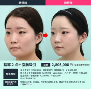輪郭2点のビフォーアフター