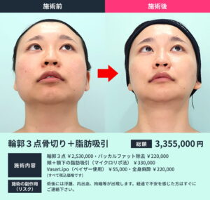 『エラ削りで後悔する理由とは？骨切りで失敗しないためのポイントと症例を紹介』の画像