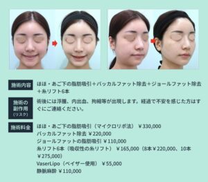 顔と顎下の比較説明と施術内容料金