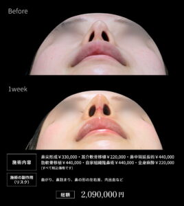 鼻フル整形のビフォーアフター01