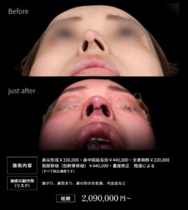 鼻フル整形のビフォーアフター02