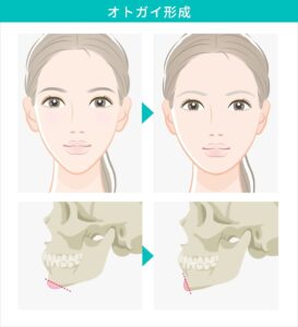 オトガイ形成による顔の変化と骨格図