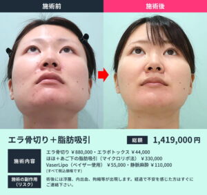 エラ骨切りのビフォーアフター