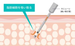 脂肪吸引器が脂肪細胞を吸い取る様子