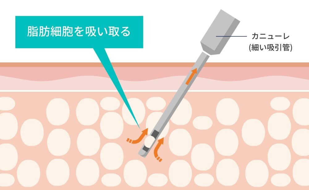 脂肪吸引器が脂肪細胞を吸い取る様子