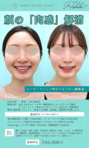脂肪吸引と脂肪除去後のビフォーアフター