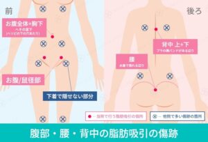 腹部腰背中の脂肪吸引における傷跡の図解