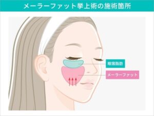 メーラーファット挙上術の施術箇所のイラスト