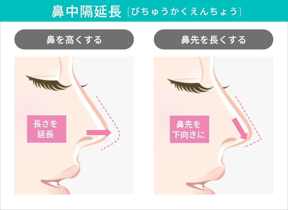 鼻中隔延長による鼻の美容整形の説明図