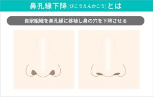 鼻孔縁下降術による鼻の穴の変化