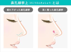 鼻孔縁挙上による鼻孔の形状変化の比較