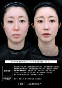鼻フル整形(修正)のビフォーアフター