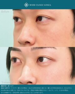 裏ハムラ法と涙袋形成併用のビフォーアフター