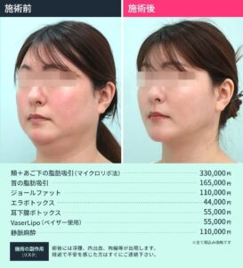 顎下脂肪吸引併用手術のビフォーアフター02