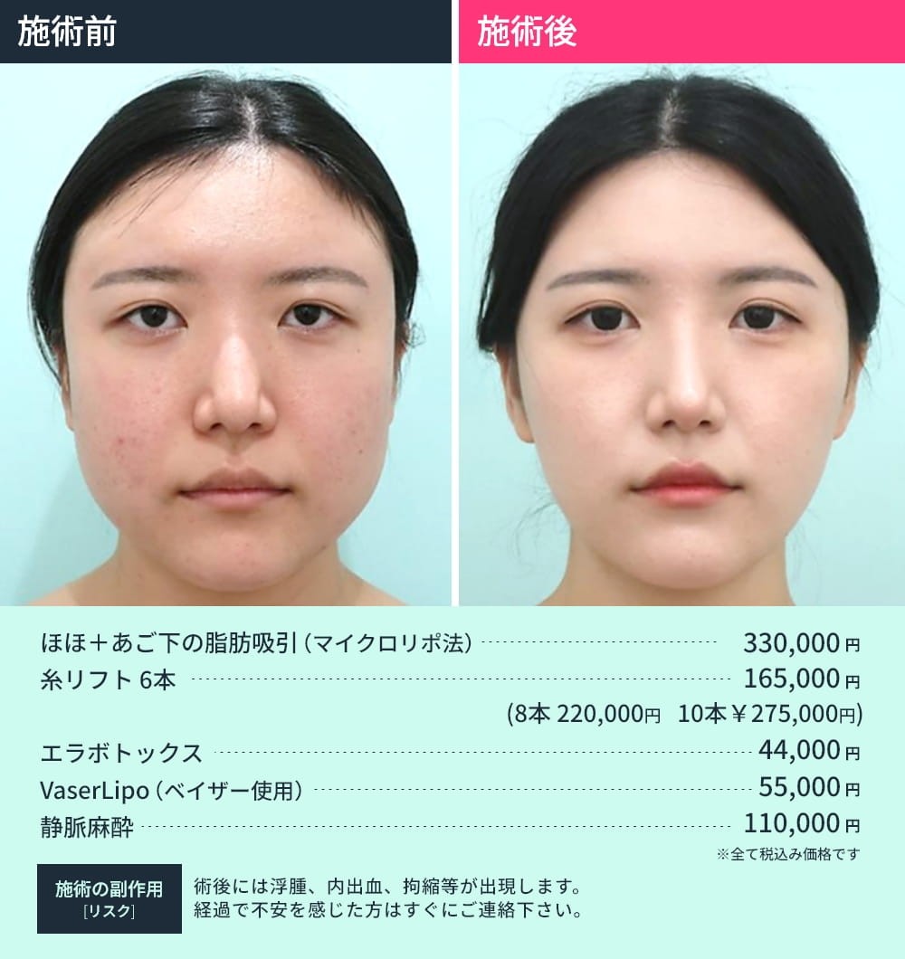顎下脂肪吸引併用手術のビフォーアフター03