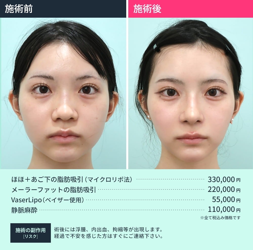 顎下脂肪吸引併用手術のビフォーアフター04