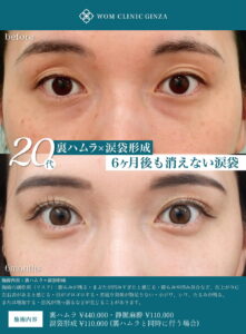 涙袋形成の症例