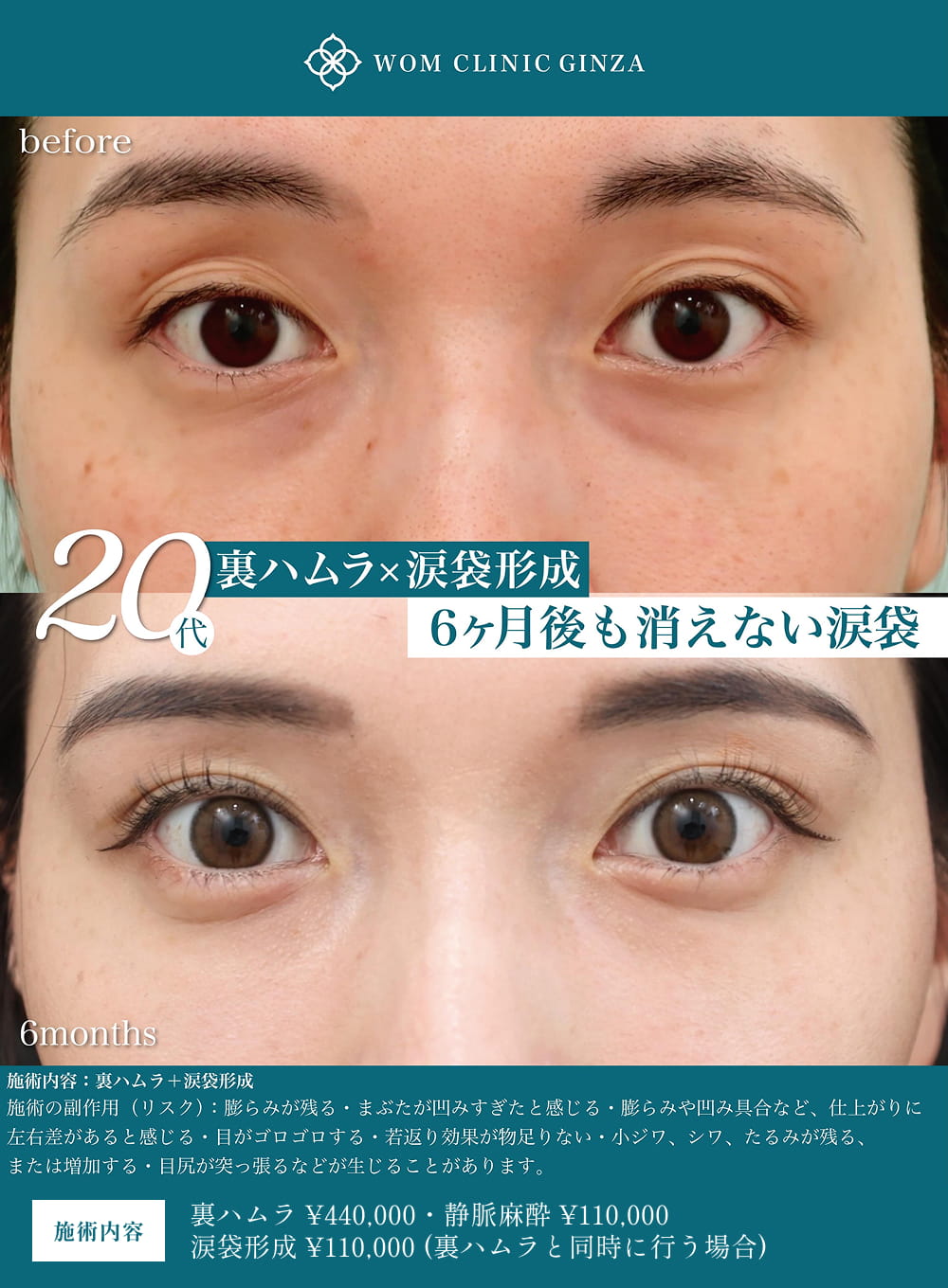 涙袋形成の症例