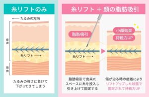 糸リフトの挿入層と脂肪吸引との併用イラスト