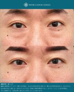 裏ハムラ法のビフォーアフター02