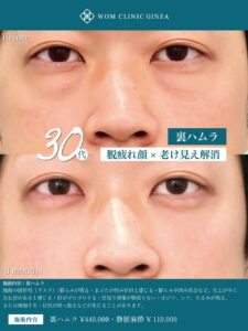 裏ハムラ法のビフォーアフター01