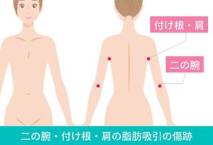 二の腕・肩・付け根の脂肪吸引