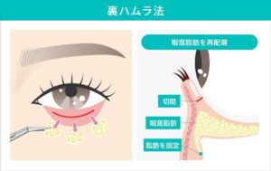 裏ハムラ法の切開位置と固定位置のイラスト