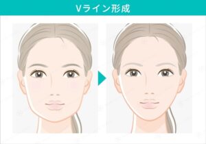 Vライン形成の施術前と施術後の比較