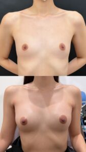 『【確実な変化はシリコンで】Aカップ→Dカップへ！翌日から内出血ゼロの症例』の画像