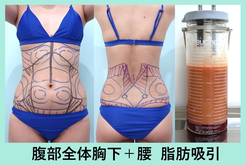 40代のガッツリ大量脂肪吸引でも「タルミ最小限」に! 美しいクビレを作る 術前デザインと吸引脂肪の写真