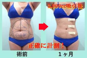 ウエスト -13cm! 純脂肪3,000cc吸引の凄い実力 術前と術後の比較写真