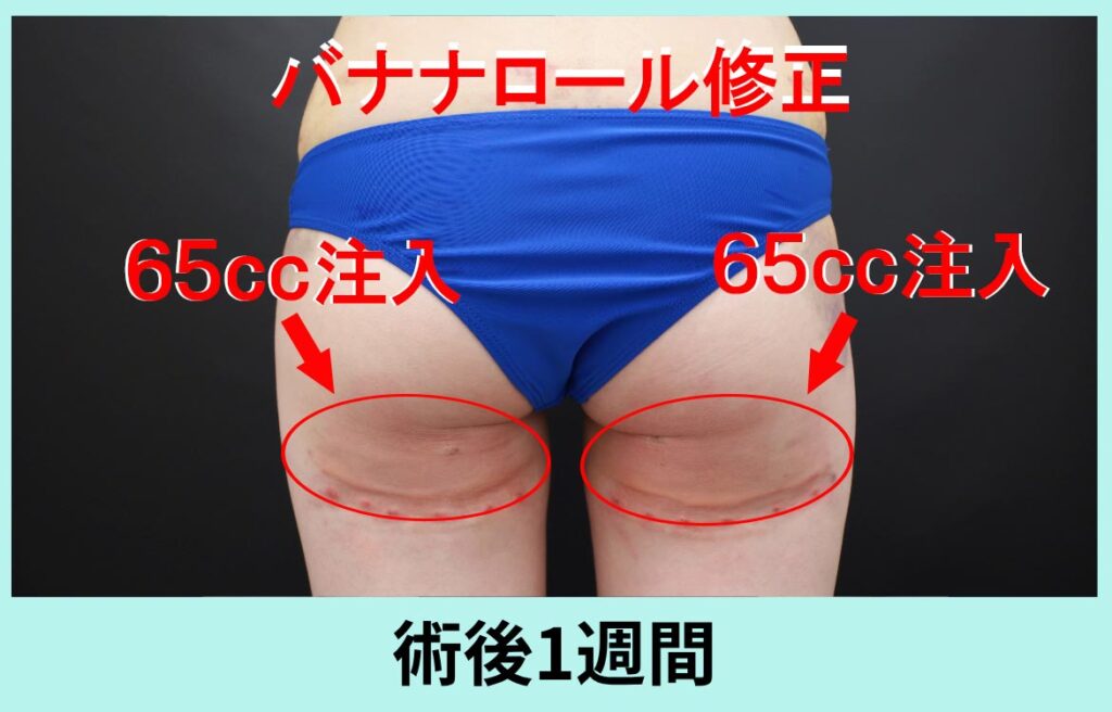 バナナロール修正手術