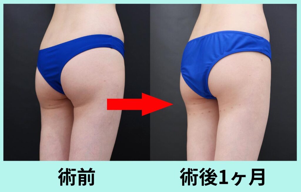 バナナロール修正手術