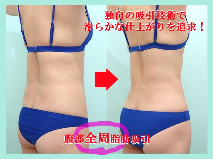 「鬼クビレ」作成術の劇的ビッフォーアフター 術前術後比較写真