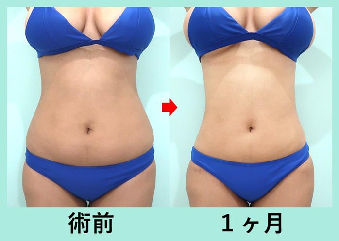 3,000cc脂肪吸引+脂肪豊胸で超メリハリボディへ!大量吸引脂肪の再配置! 術前術後比較写真