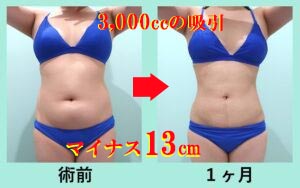 ウエスト -13cm! 純脂肪3,000cc吸引の凄い実力 術前と術後の比較写真